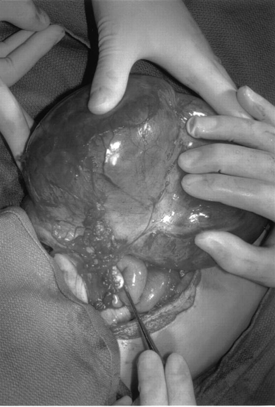 The cause of the mutation of the PTEN gene (a tumor).